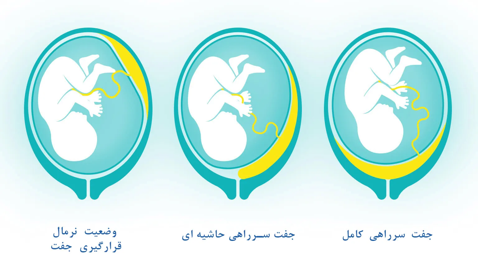 جفت سر راهی در هفته 36 بارداری