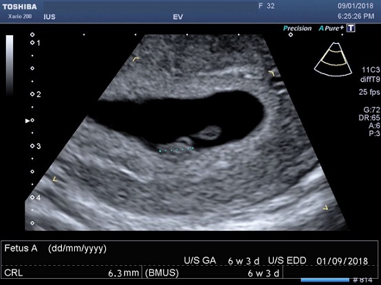 اولین سونوگرافی بارداری در هفته ششم بارداری