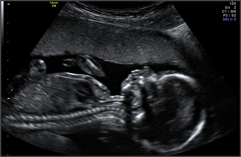 سونوگرافی در هفته هفدهم بارداری